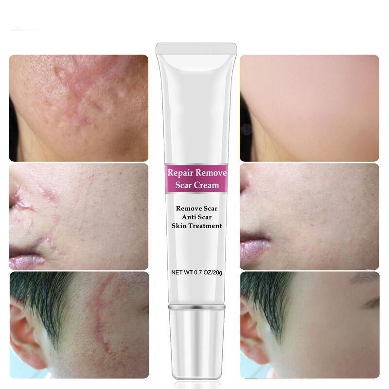 RtopR Facial Body Scar Removal Cream Repair Skin Weaken Marks Eliminate Pimple Promote Horny Layer Updating