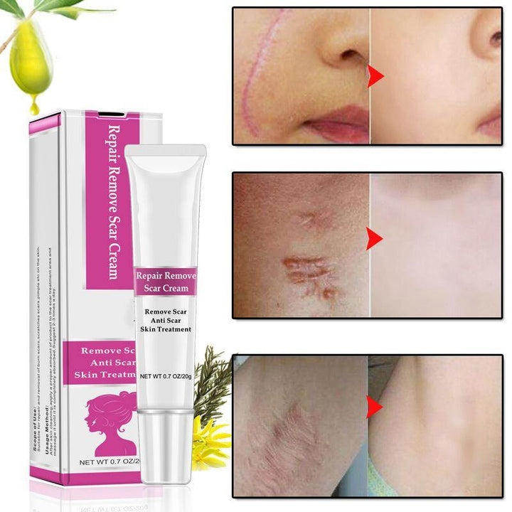 RtopR Facial Body Scar Removal Cream Repair Skin Weaken Marks Eliminate Pimple Promote Horny Layer Updating