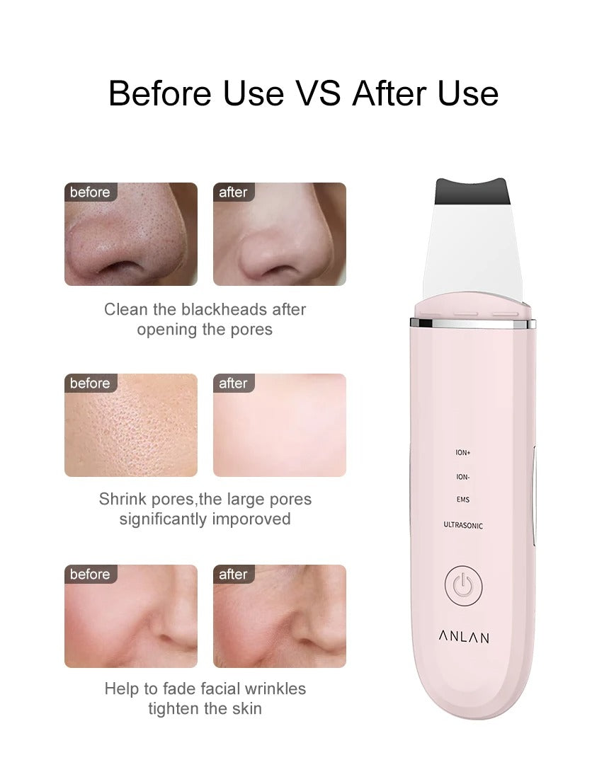 Ultrasonic Skin Scrubber | Deep Cleansing Facial Peeling Shovel | Pore and Blackhead Removal Tool